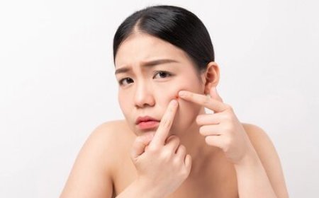 Mencegah Jerawat: Tips Sederhana untuk Kulit Bersih dan Sehat