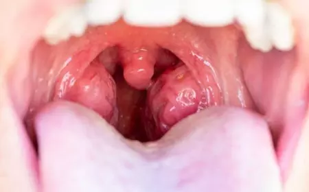 Radang Amandel Tak Kunjung Sembuh? Ini Dia Penjelasannya!