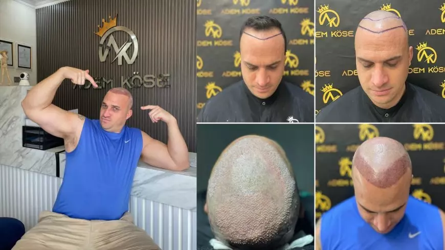 Ademkose Hair Transplant Hadir di Indonesia, Siap Jadikan Yogyakarta Pusat Medical Tourism Dunia